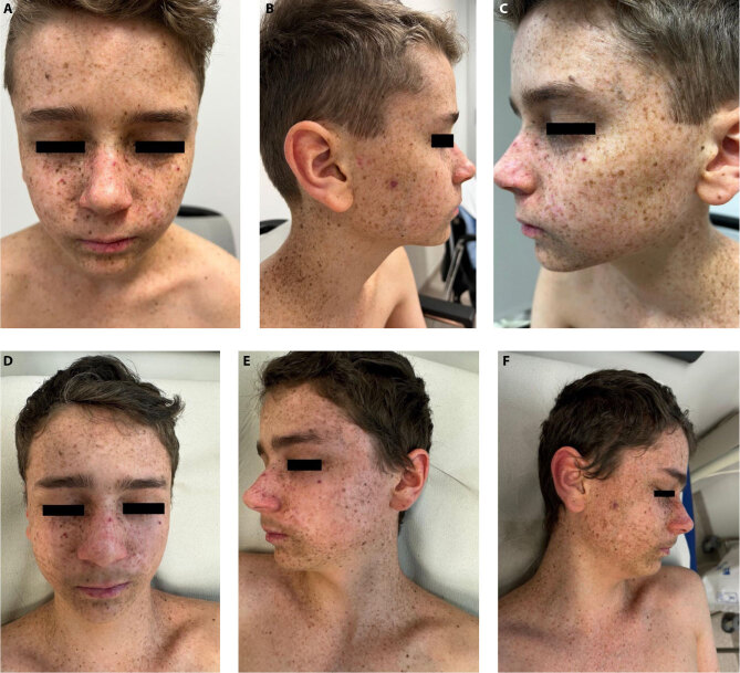 Effective Sequential and Rotational Therapy in a Patient With Xeroderma Pigmentosum.