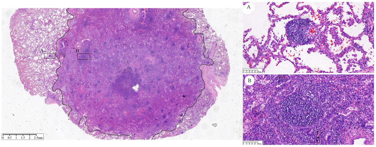 Prognostic Value of Tertiary Lymphoid Structures in Stage I Nonsmall Cell Lung Cancer: Does Location Matter?