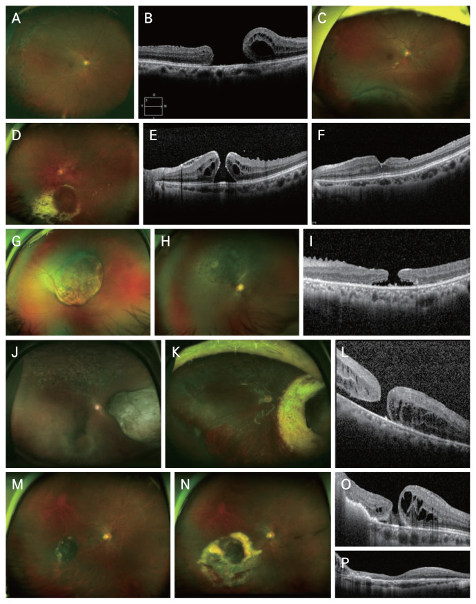 Coexisting Macular Hole and Uveal Melanoma: A Case Series and Literature Review.