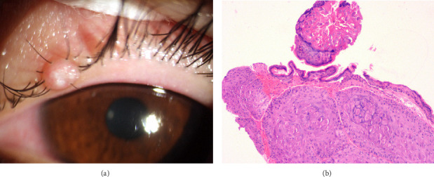 Clinical Diagnosis and Novel Treatment of Eyelid Molluscum Contagiosum.
