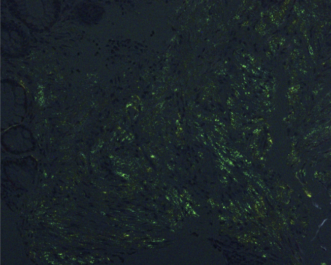 Periorbital Purpura as a Key Diagnostic Clue in Immunoglobulin Light Chain Amyloidosis.