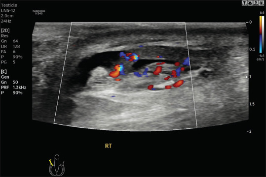 Acute Scrotal Pain - Role of Sonographic Evaluation in Solving Diagnostic Dilemma.