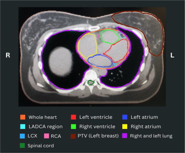 Cardiac substructure dose distributions in node-positive and node-negative breast cancer patients undergoing 3D-CRT: comparing the predictive accuracy of mean heart dose and mean left ventricular dose.