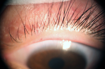 Clinical Diagnosis and Novel Treatment of Eyelid Molluscum Contagiosum.