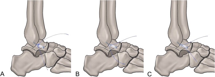 All-inside arthroscopic procedures for chronic lateral ankle instability: evidence-based clinical practice guidelines.
