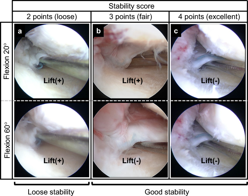 The preoperative flexion tear gap affects postoperative meniscus stability after pullout repair for medial meniscus posterior root tear.