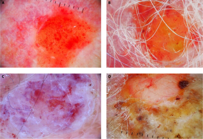 Erosive Pustular Dermatosis of the Scalp Mimicking Squamous Cell Carcinoma: Can Dermoscopy Be Helpful?