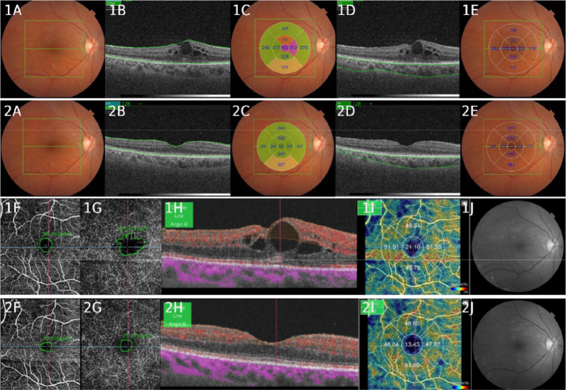 Prospective and dichotomous study of biomarkers with swept-source OCT and OCT-angiography in naive patients with diabetic macular edema.