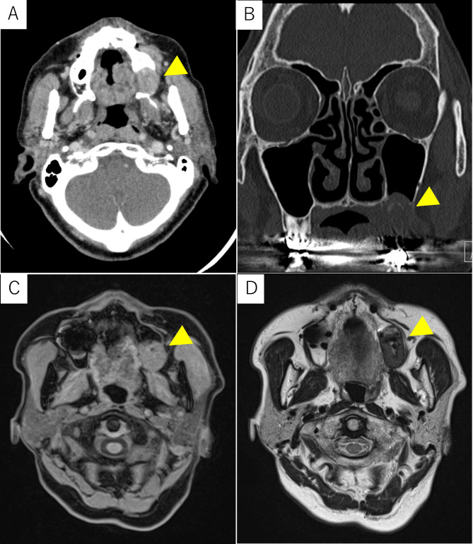A case of phosphoglyceride crystal deposition disease in the maxilla.