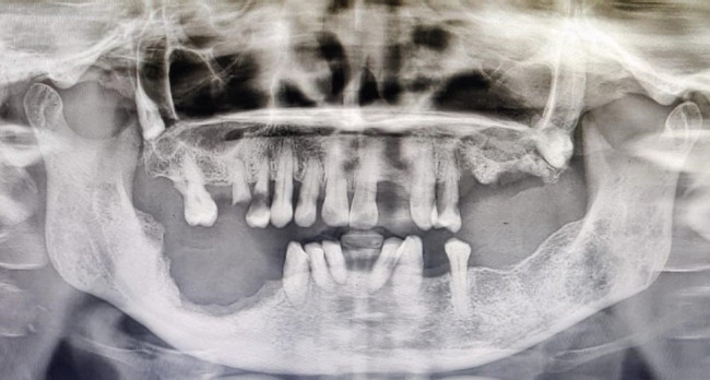 Multidisciplinary approach for medication-related osteonecrosis of the jaws: a case report and literature review.