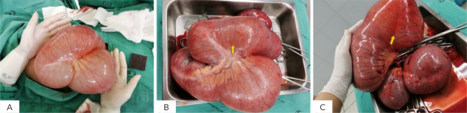 Jejunal Duplication in a 10-Year-Old Boy Presenting with Generalized Oedema and Abdominal Distension.