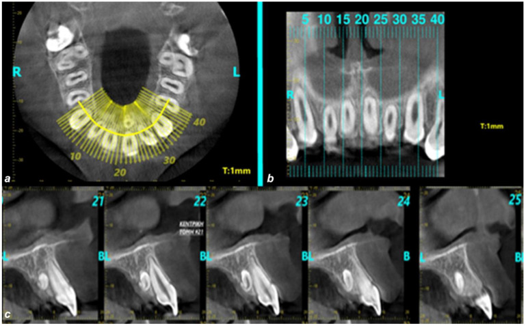 Supernumerary Teeth in the Anterior Maxilla of Non-Syndromic Children and Adolescents: A Retrospective Study Based on Cone-Beam Computed Tomography Scans.