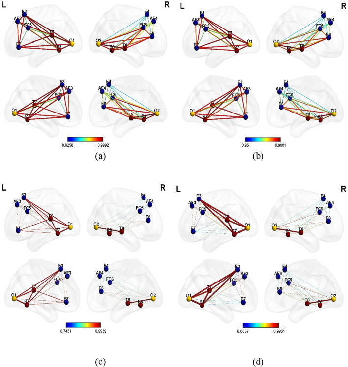 Music interventions and obstructive sleep apnea: a brain connectivity analysis.