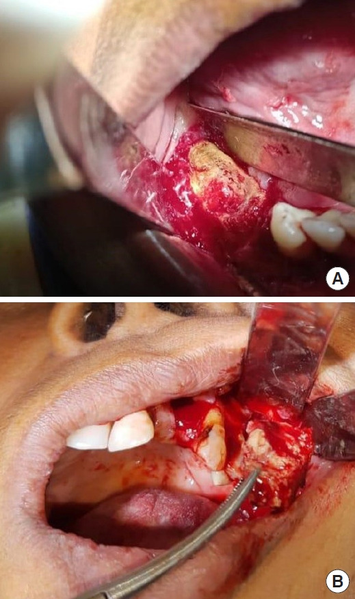 Multidisciplinary approach for medication-related osteonecrosis of the jaws: a case report and literature review.
