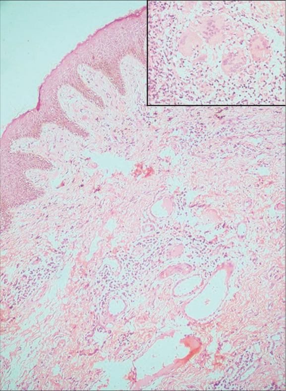 Platelet-rich fibrin therapy as an adjuvant treatment in the management of metastatic Crohn's disease: A case series.