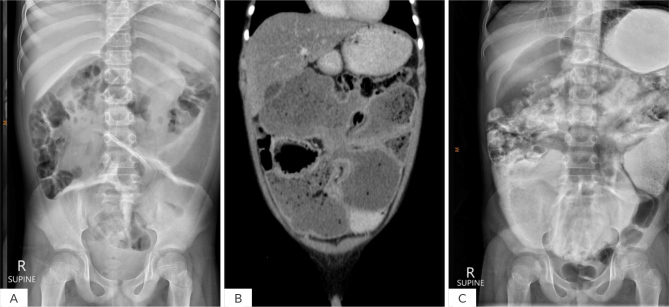 Jejunal Duplication in a 10-Year-Old Boy Presenting with Generalized Oedema and Abdominal Distension.