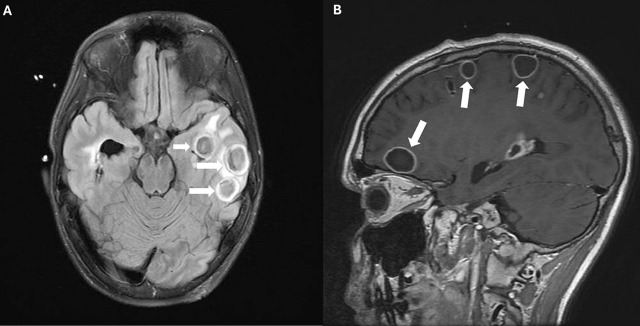 The use of intraventricular vancomycin in subacute brain abscess in an adolescent male: A case report.