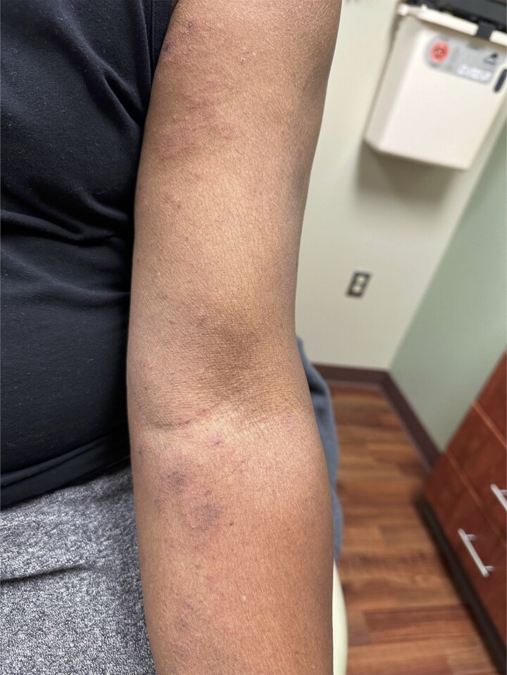 Iododerma Following Radioactive Iodine Therapy in Thyroid Cancer: Insights From 2 Cases.