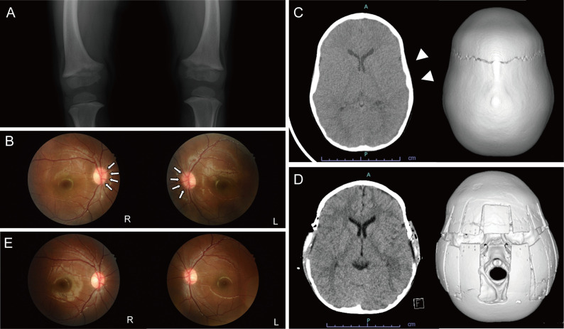 Significance of assessing the severity of craniosynostosis in patients with X-linked hypophosphatemia (XLH) at diagnosis.