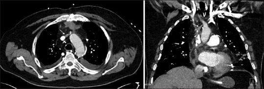 Misplacement of a Left Internal Jugular Central Venous Catheter in the Pericardiophrenic Vein.