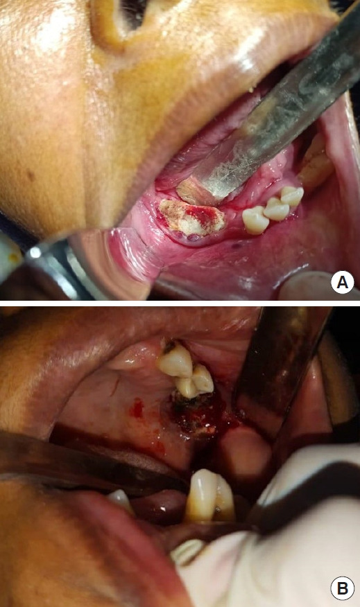 Multidisciplinary approach for medication-related osteonecrosis of the jaws: a case report and literature review.