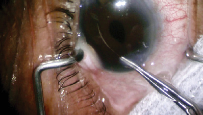 Eyelash Impalement of Iris After Uncomplicated Cataract Surgery.