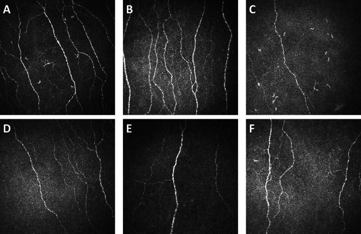 Small Fibre Pathology in Fibromyalgia: A review.