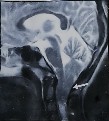 A Case Report of Dental Management of Patient With Arnold Chiari I Malformation.