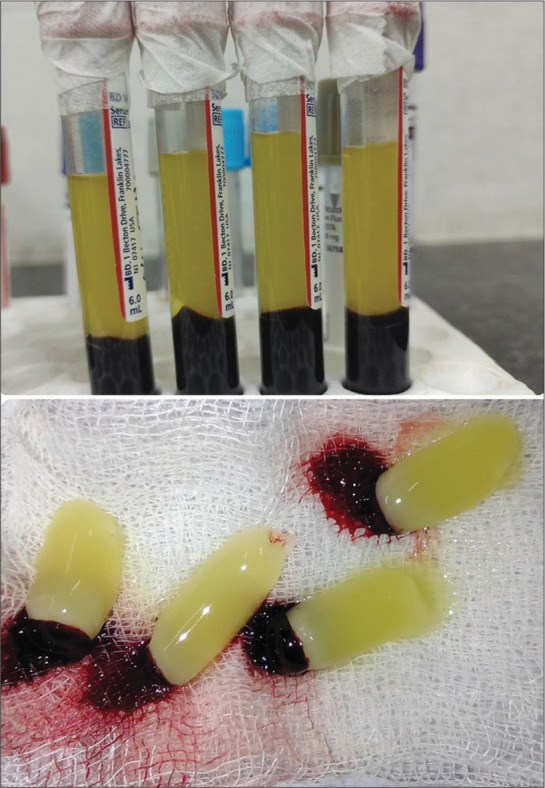 Platelet-rich fibrin therapy as an adjuvant treatment in the management of metastatic Crohn's disease: A case series.
