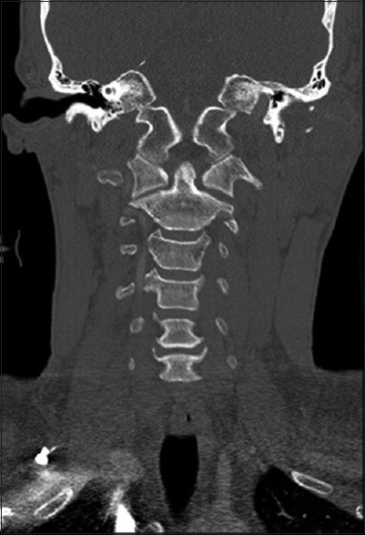 Unilateral C1-C2 vertical distraction injuries: Can we treat conservatively?