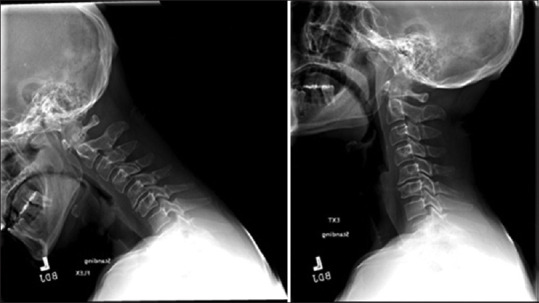 Unilateral C1-C2 vertical distraction injuries: Can we treat conservatively?