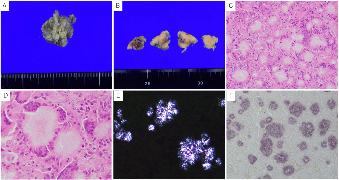 A case of phosphoglyceride crystal deposition disease in the maxilla.