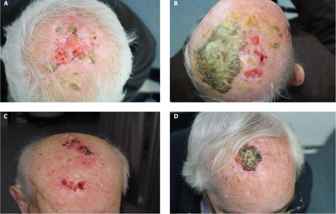 Erosive Pustular Dermatosis of the Scalp Mimicking Squamous Cell Carcinoma: Can Dermoscopy Be Helpful?