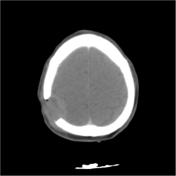Lytic bone lesion of the skull as a rare manifestation of hepatocellular carcinoma: a case report.