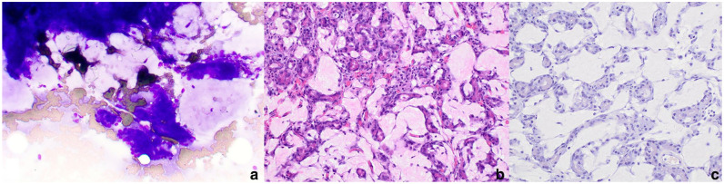 Hyalinizing pancreatic adenocarcinoma in a cat.
