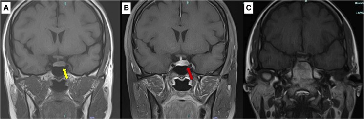 ACTH-dependent Cyclic Cushing Syndrome With Successful Pregnancy and Early Postpartum Relapse.