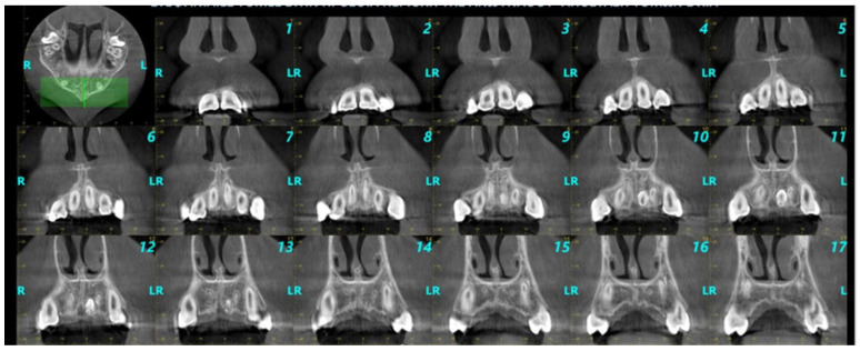 Supernumerary Teeth in the Anterior Maxilla of Non-Syndromic Children and Adolescents: A Retrospective Study Based on Cone-Beam Computed Tomography Scans.