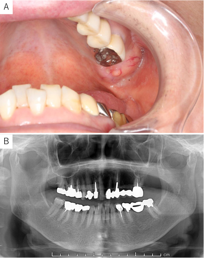 A case of phosphoglyceride crystal deposition disease in the maxilla.