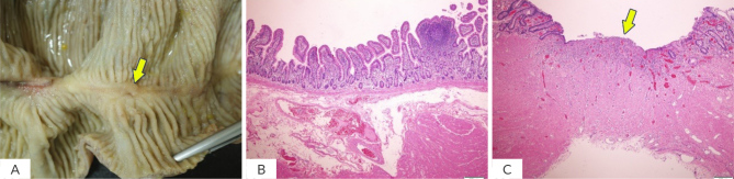 Jejunal Duplication in a 10-Year-Old Boy Presenting with Generalized Oedema and Abdominal Distension.