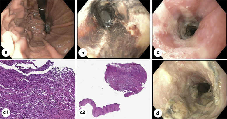 An Unusual Complication of Diverticular Bleed: Dysphagia and Food Impaction from Black Esophagus.