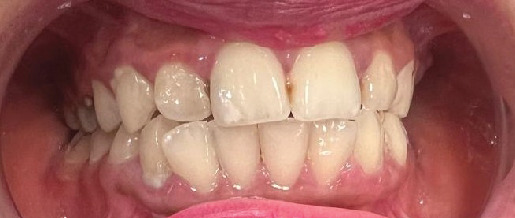 A Case Report of Dental Management of Patient With Arnold Chiari I Malformation.