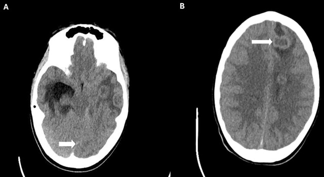 The use of intraventricular vancomycin in subacute brain abscess in an adolescent male: A case report.