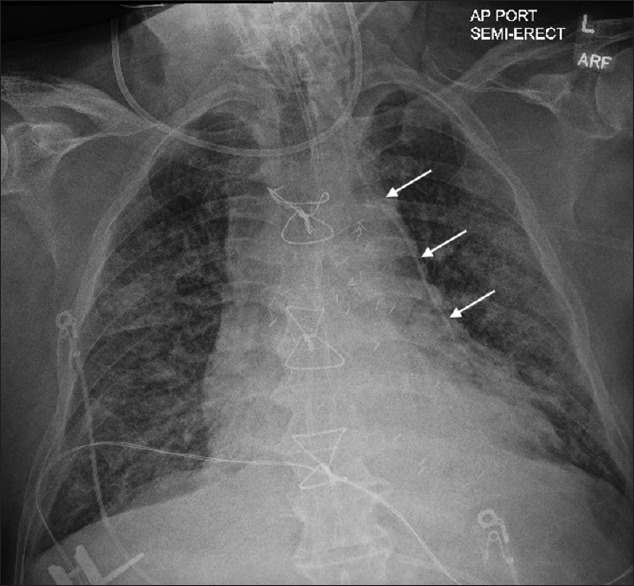 Misplacement of a Left Internal Jugular Central Venous Catheter in the Pericardiophrenic Vein.