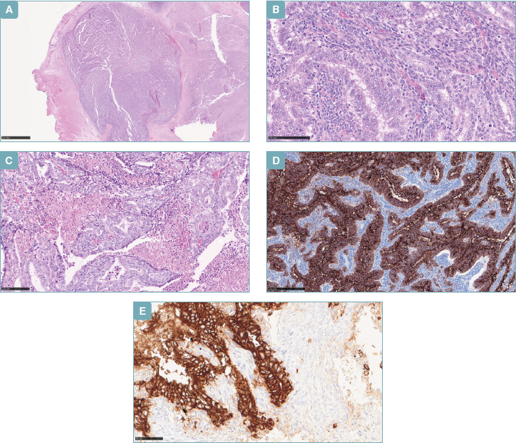 Head and neck synovial sarcoma in a woman with previous lymphoma and papillary thyroid carcinoma.