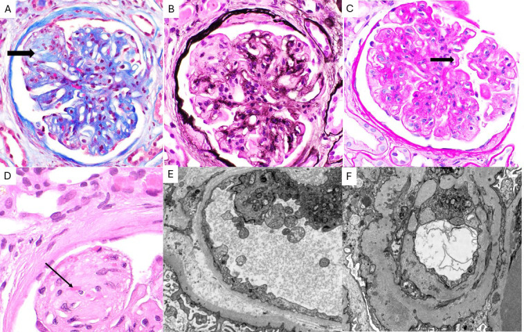Sunitinib induced glomerular thrombotic microangiopathy in a patient with refractory pancreatic neuroendocrine tumour.