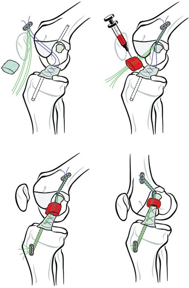 Indications, Techniques, and Outcomes of Bridge-Enhanced ACL Restoration (BEAR).