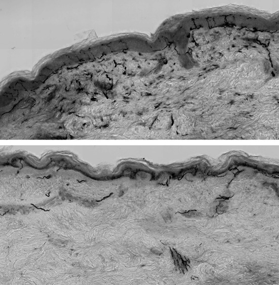 Small Fibre Pathology in Fibromyalgia: A review.