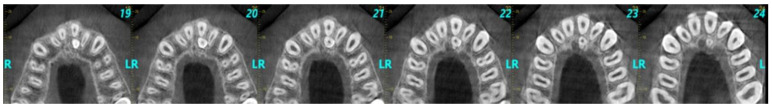 Supernumerary Teeth in the Anterior Maxilla of Non-Syndromic Children and Adolescents: A Retrospective Study Based on Cone-Beam Computed Tomography Scans.