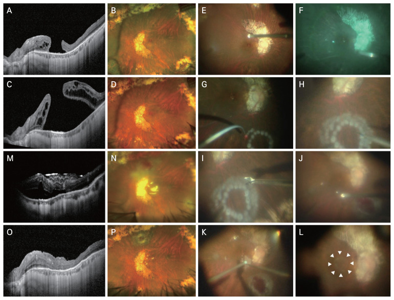 Refractory Macular Hole with Retinal Detachment Treated with Autologous Retinal Transplantation: A Case Report.
