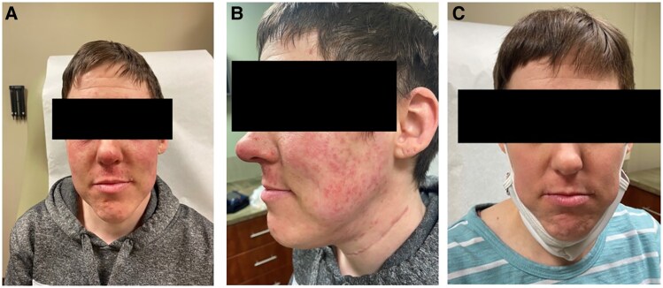 Iododerma Following Radioactive Iodine Therapy in Thyroid Cancer: Insights From 2 Cases.